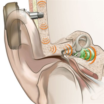 Image demonstrating how the Bone Anchored Hearing Aid (BAHA) fits to the patient