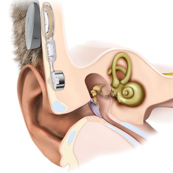 Illustration showing how the BoneBridge hearimg implant fits the patient