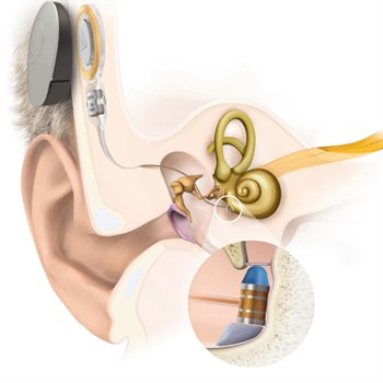 Illustration showing how the middle ear system fits the patient