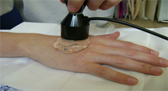 Hand Therapy Ultrasound Treatment